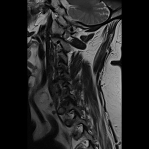 Cervical Foraminal Stenosis
