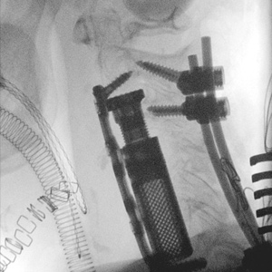 Complex cervical spine surgery