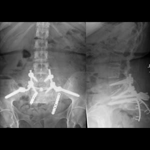 Lumbar Spine Surgery (Spino-pelvic fixation)