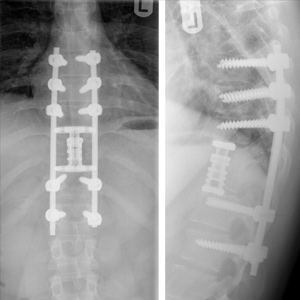 Complex Thoracic Spine Surgery