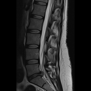 Lumbar Disc Herniation