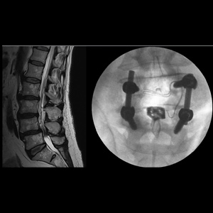 Lumbar Fusion