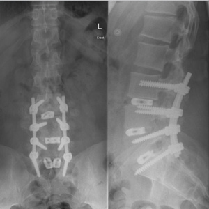 Lumbar fusion (TLIF) 