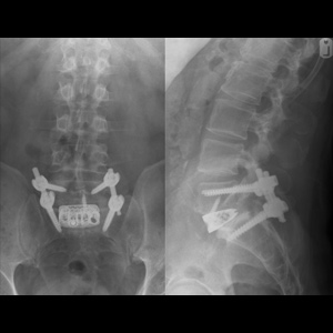 Spinal stenosis (Thoracic)