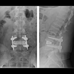 Minimally Invasive Lumbar Fusion (XLIF)