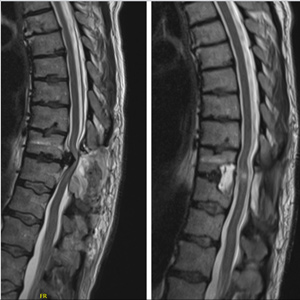 Minimally Invasive Surgery for Thoracic Disc Herniation