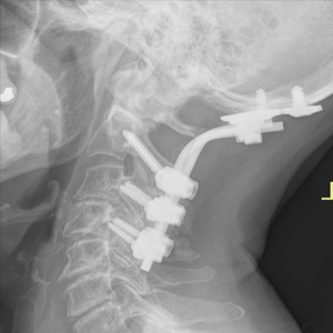 Occipito-cervical Fusion
