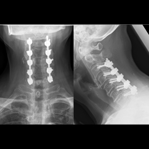 Posterior Cervical Fusion