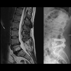 Revision Lumbar Fusion Surgery