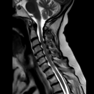 Spinal stenosis (Cervical)