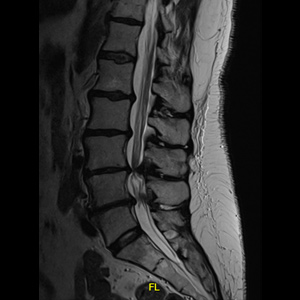 Spinal stenosis (Lumbar)