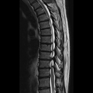 Spinal stenosis (Thoracic)