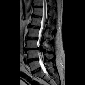 Spondylolisthesis