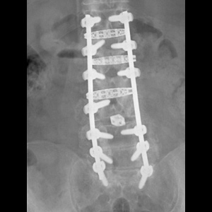 Thoraco Lumbar Fusion